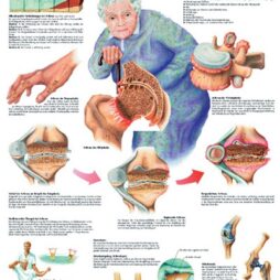 Anatomical Chart - Arthritis, laminated