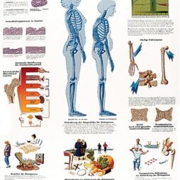 Anatomical Chart - Osteoporosis,  laminated