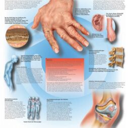 Anatomical Chart - Rheumatic Diseases,  laminated