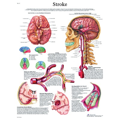 Anatomical Chart - Stroke Chart,  laminated